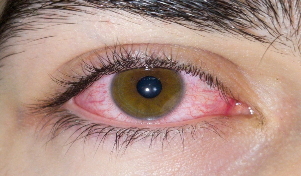 Dry Eye Syndrome: आंखों में जलन-चुभन है ड्राई आई का संकेत, तुरंत जानें बचाव और असरदार इलाज
