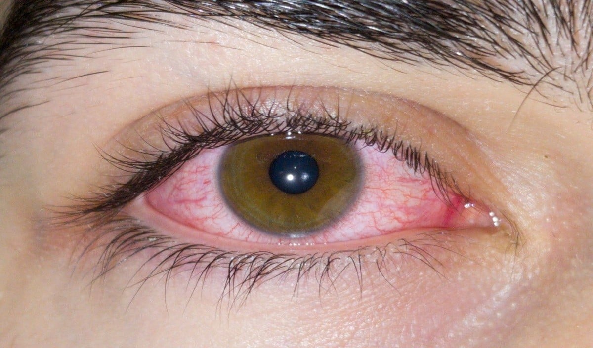 Health Tips: Heatwave का आंखों पर ‘साइलेंट अटैक’, बढ़ रहा Redness और Infection का खतरा, जानें ये Eye Care Tips
