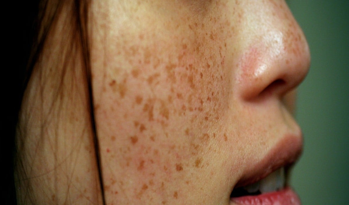 Summer Health: क्या पेट की गर्मी से चेहरे पर होते हैं Pimples? जानें इस दावे का पूरा सच